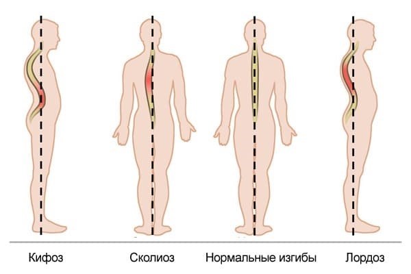 Степень кифоза